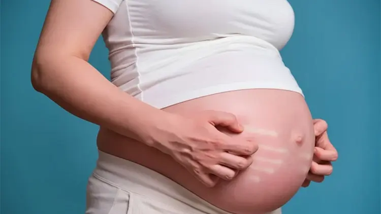 Hamilelikte Kaşıntı